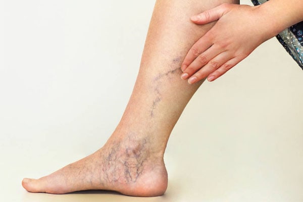 Ratings & Reviews - San Diego Varicose Vein Treatment Center