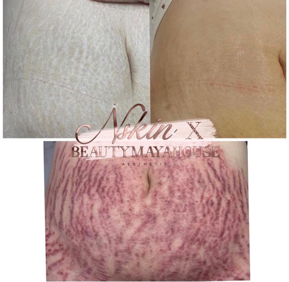 Nskins Treatment stretch marks – Maya Beauty House